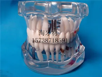 Стоматологични материали подвижен модел на пасти за зъби патологична модел на зъба Кристални зъби на зъбни стоматологични материали